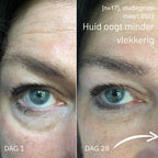 Vervaag je pigmentlvlekken met deze crème of je geld terug [crème + maskers + verzending]